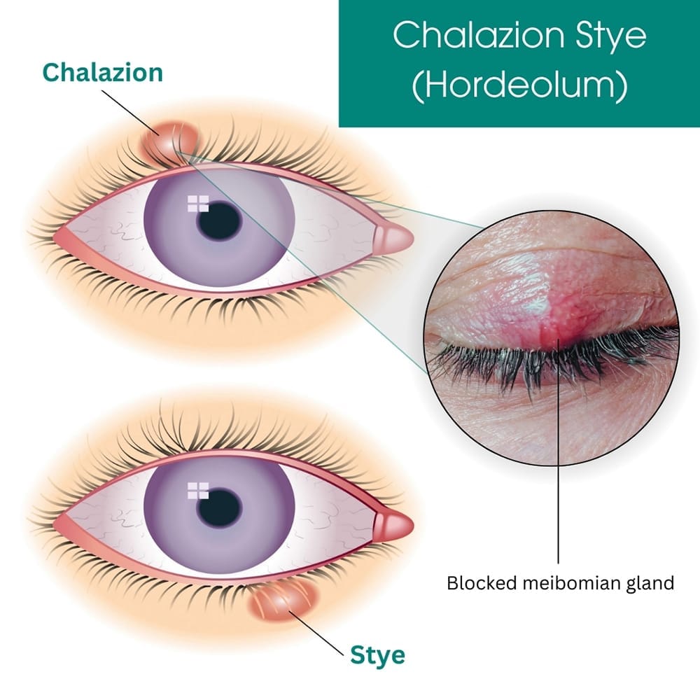 Chalazion Stye (Hordeolum)